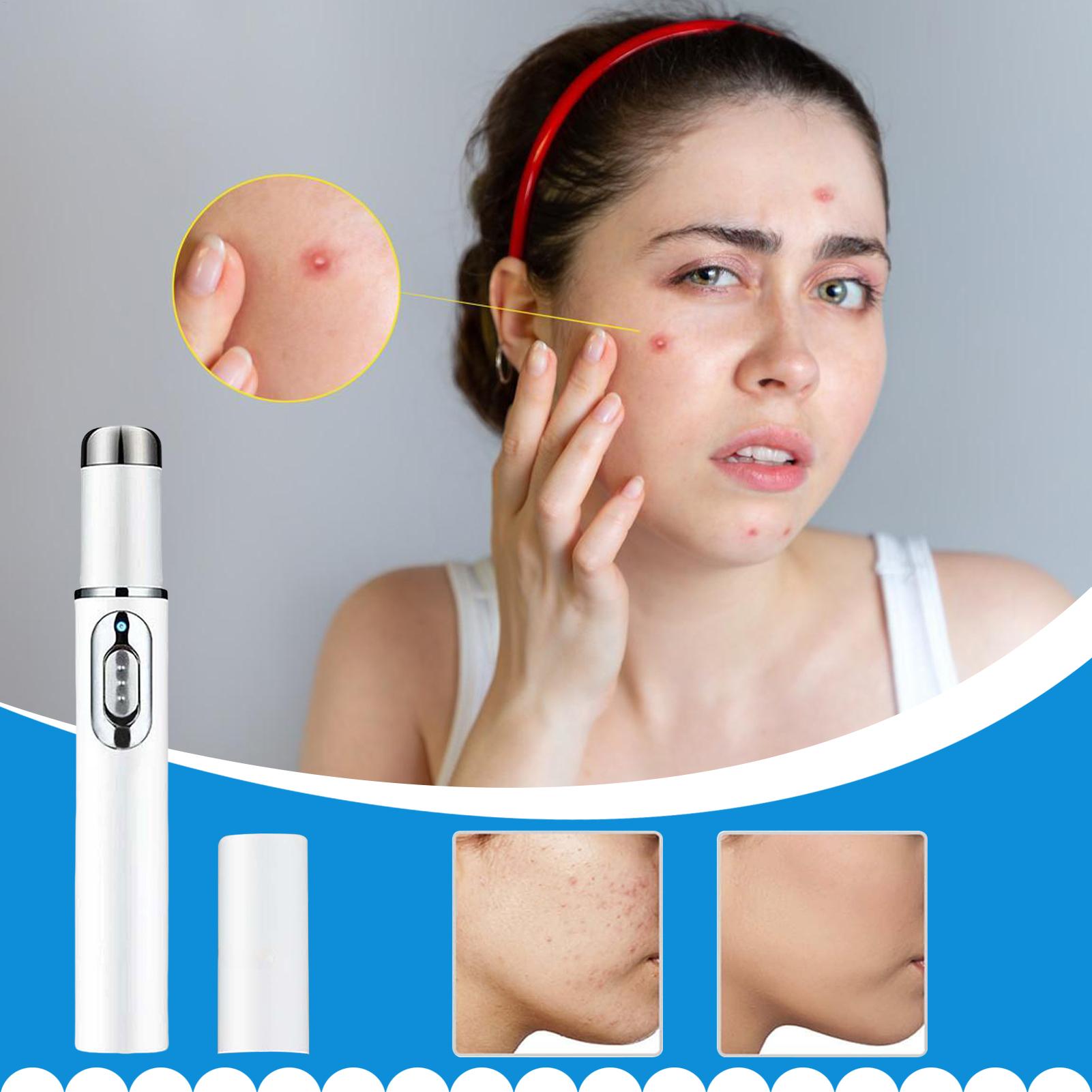 Mole Remover Pen Portable Skin - đánh giá và giá Women Accessories Combo